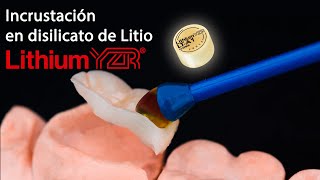 Incrustación en disilicato de litio Lithium YZR [upl. by Rases]