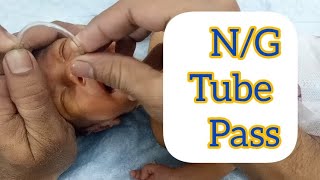 Nasogastric NG Tube insertion in neonateNewborn  How to place a nesogastric  NG feeding tube [upl. by Ardell]