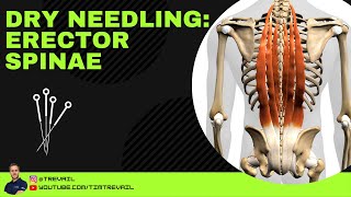 Dry Needling Erector Spinae [upl. by Weeks]