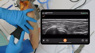 UltrasoundGuided Biceps Tenodesis [upl. by Myna]