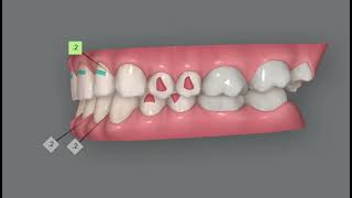 Invisalign Clincheck simulation Correction of deep bite and traumatic occlusion Delicate case [upl. by Onateag]