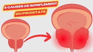 5 causes de gonflement du prostate  prostate doctor  prostate treatment options  prostate dr [upl. by Elidad]