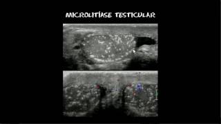 Microlitíase testicular [upl. by Lenahc925]