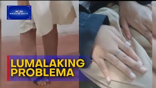 Dalaga sa Zamboanga del Norte lumalaki ang paa at mga daliri sa kamay  MukhaNgBalita [upl. by Rois467]