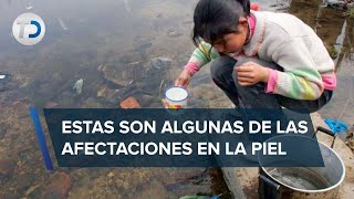 Mala calidad del agua en casa podría causar esquistosomiasis dermatóloga [upl. by Lemuela]