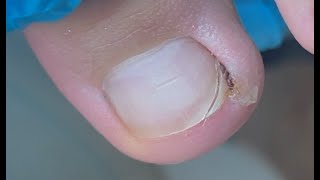 Nail got damaged on toe edge [upl. by Anihsak]