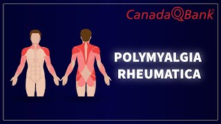 Polymyalgia Rheumatica [upl. by Marilin]