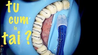 eficientizarea procesului de ablatie dentara voiceover [upl. by Haran]