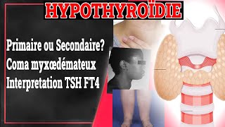 HYPOTHYROÏDIE  Primaire ou Secondaire Biologie Traitement  Endocrinologie Medicale [upl. by Maud851]