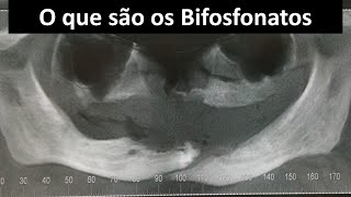 O que são os Bifosfonatos  Odontologia  Dra Bianca Rosa [upl. by Ag585]