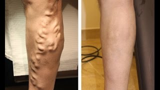 After Watching THIS Youll Learn How To Get Rid of Varicose Veins Naturally [upl. by Orland]