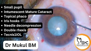 small pupil int mat cat Topical phaco  Iris hooks [upl. by Derrek]