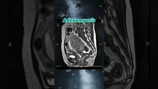 ADENOMYOSIS in SPANISH  Work Vocabulary  Medical Interpreter Training [upl. by Colner52]