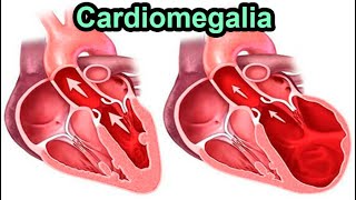 🔴 CARDIOMEGALIA ¿QUE ES [upl. by Laetitia]