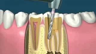Tratamentul de canal [upl. by Bibah617]