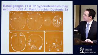 Clinical Pearls in Autoimmune Encephalopathy  Eoin Flanagan MD [upl. by Selassie]