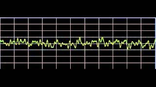 Bruxism Teeth Grinding  Rife Frequencies [upl. by Ayeki]