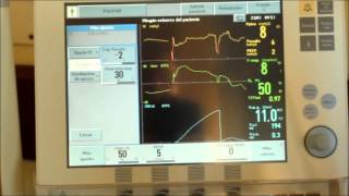 SPONTANEOUS BREATHING TRIAL NEGATIVE INSPIRATORY FORCE NIF SERVO I MAQUET [upl. by Lledraw]