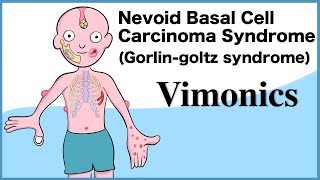 Nevoid Basal Cell Carcinoma Syndrome Gorlingoltz syndrome Visual mnemonics [upl. by Robbert752]