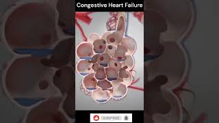 Congestive Heart Failure Explain 3DAnimation shorts [upl. by Merriman]