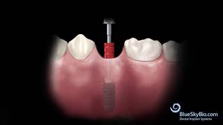 Tissue Level implant and UCLA Abutment [upl. by Lobel]