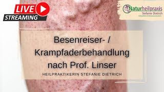 Sanfte Saline Besenreiser amp Krampfaderbehandlung nach Prof Linser  ambulant  Heilpraktiker [upl. by Elburt]