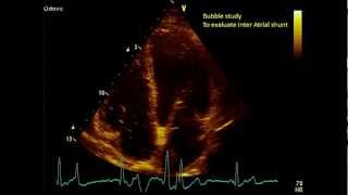 Apical views  Transthoracic Echocardiogram TTE [upl. by Aynav119]