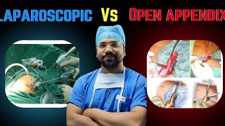 Laparoscopic vs open appendectomy l educationalvideo appendicitis surgeons jamui yt trending [upl. by Atat]