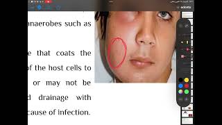 Odontogenic infections4th stage oral surgery part2 [upl. by Suaeddaht]