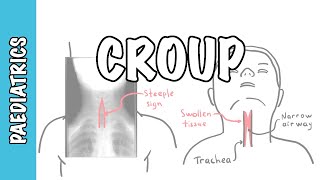 What is Croup larynotracheobronchitis  symptoms pathophysiology investigations treatment [upl. by Hafirahs]