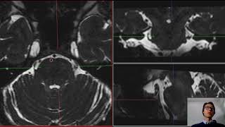 como avaliar neuralgia do trigêmeo através do exame de imagem [upl. by Anivahs770]