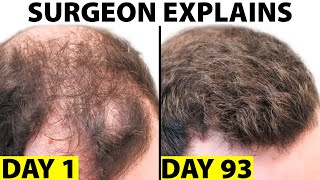 Oral Minoxidil  A Better Hair Loss Treatment [upl. by Phoebe]