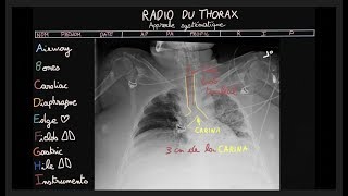 Radio du thorax  ABCDEFGHI  Partie 2  Docteur Synapse [upl. by Kcireddor]