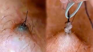 How to Prevent amp Treat Ingrown Hairs [upl. by Binny]