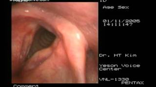 Laryngoplasty of sulcus vocalis [upl. by Lundquist]