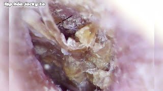 Ear Wax Removal 120 Earwax Makes Me itch Like Crazy Please Take It Out  Ear Cleaning ASMR [upl. by Otreblasiul]