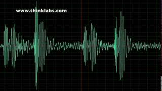 Aortic Stenosis [upl. by Rosse]