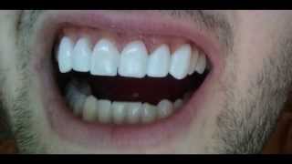 Non Prep Veneers bad experience and high cost [upl. by Barthel]