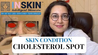 What is cholesterol spot and how to treat it dermatologist xanthelasma xanthelasmatreatment [upl. by Arlette]