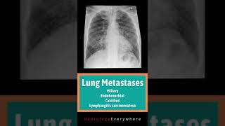 Lung Metastases Miliary Endobronchial calcified Lymphangitic carcinomatosis Radiology Video 40 [upl. by Lacram]