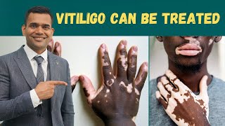 Vitiligo Leucoderma  Can Be Treated  Herbs And Vitamins To Treat Vitiligo  Dr Vivek Joshi [upl. by Atinas]