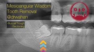 Mesioangular Wisdom Tooth Extraction just like in the Textbook [upl. by Gnol665]