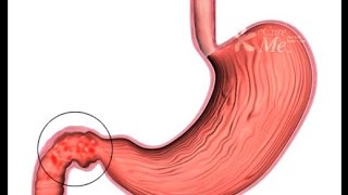 DUODENITIS INFLAMACIÓN DEL DUODENO [upl. by Ylil]