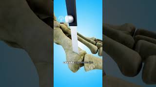 How Bunion Surgery Can Transform Your Foot Health 😲 shorts viralvideo  Creativelearning3d [upl. by Islaen]