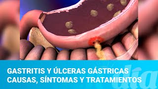 Gastritis y úlceras gástricas causas síntomas y tratamientos [upl. by Hefter]