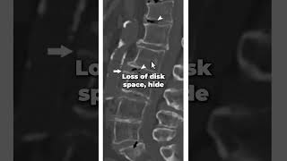 What does spinal degenerative disc disease look like [upl. by Eissehc]