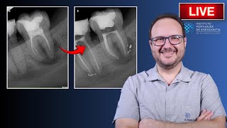 Endo Rtx of 🦷37 with EndoPerio Lesion ▶️ Part 2 [upl. by Eiralav]