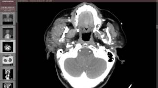 Parotitis with parotid duct stone [upl. by Sutphin]