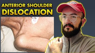 Anterior Shoulder Dislocation PathoAnatomy Reduction techniques Clinical Features amp Complications [upl. by Hcaz]