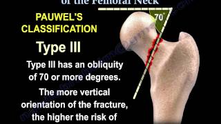 Femoral Neck fracture Classifications  Everything You Need To Know  Dr Nabil Ebraheim [upl. by Aner470]